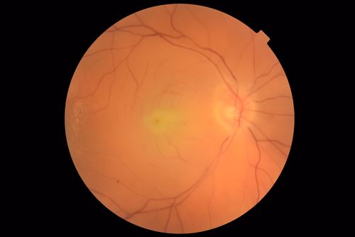 Central Retinal Artery Occlusion - Diabetic Retinopathy - NO cherry red spot
58 year old man with sudden vision loss in the right eye.  The vision had been 20/40 and dropped to 20/200 the day prior to presentation.  
VA 20/200 OD, 20/20 OS
FA shows CRAO.  No cherry red spot.
