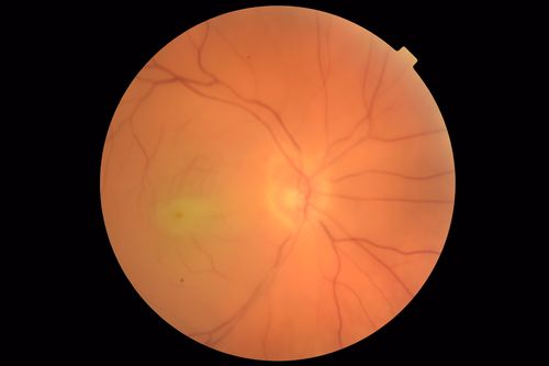 Central Retinal Artery Occlusion - Diabetic Retinopathy - NO cherry red spot
58 year old man with sudden vision loss in the right eye.  The vision had been 20/40 and dropped to 20/200 the day prior to presentation.  
VA 20/200 OD, 20/20 OS
FA shows CRAO.  No cherry red spot.
