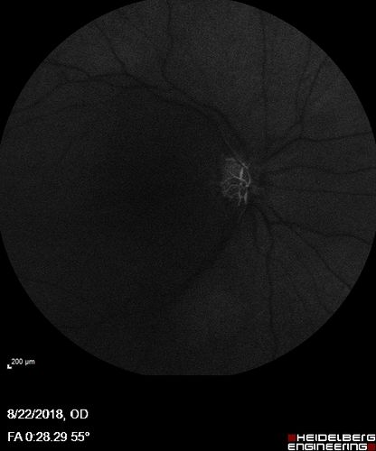 Central Retinal Artery Occlusion - Diabetic Retinopathy - NO cherry red spot
58 year old man with sudden vision loss in the right eye.  The vision had been 20/40 and dropped to 20/200 the day prior to presentation.  
VA 20/200 OD, 20/20 OS
FA shows CRAO.  No cherry red spot.
