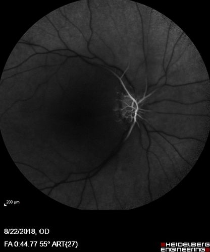 Central Retinal Artery Occlusion - Diabetic Retinopathy - NO cherry red spot
58 year old man with sudden vision loss in the right eye.  The vision had been 20/40 and dropped to 20/200 the day prior to presentation.  
VA 20/200 OD, 20/20 OS
FA shows CRAO.  No cherry red spot.
