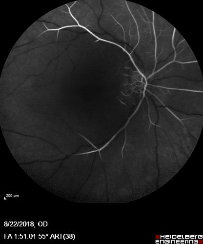 Central Retinal Artery Occlusion - Diabetic Retinopathy - NO cherry red spot
58 year old man with sudden vision loss in the right eye.  The vision had been 20/40 and dropped to 20/200 the day prior to presentation.  
VA 20/200 OD, 20/20 OS
FA shows CRAO.  No cherry red spot.
