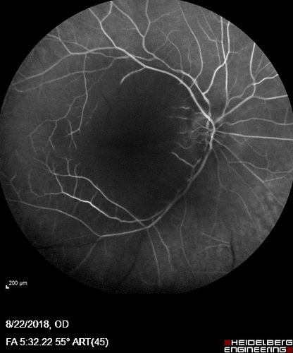 Central Retinal Artery Occlusion - Diabetic Retinopathy - NO cherry red spot
58 year old man with sudden vision loss in the right eye.  The vision had been 20/40 and dropped to 20/200 the day prior to presentation.  
VA 20/200 OD, 20/20 OS
FA shows CRAO.  No cherry red spot.

