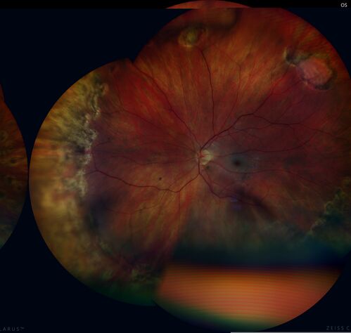 Central Retinal Artery Occlusion - Fluorescein Angiogram Video
63 year old man Sudden severe vision loss in the left eye for 3 days.  Six months following macula off retinal detachment repair, Pneumatic then PPV, then PPV buckle.  VA was 20/63 on 4/2021 (3 months post RD repair).
PMHx â€“ HTN.  Meds: HCT, Meloxicam
VA OD 20/25, OS HM
