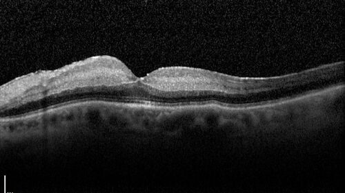 Central Retinal Artery Occlusion - Fluorescein Angiogram Video
63 year old man Sudden severe vision loss in the left eye for 3 days.  Six months following macula off retinal detachment repair, Pneumatic then PPV, then PPV buckle.  VA was 20/63 on 4/2021 (3 months post RD repair).
PMHx â€“ HTN.  Meds: HCT, Meloxicam
VA OD 20/25, OS HM
