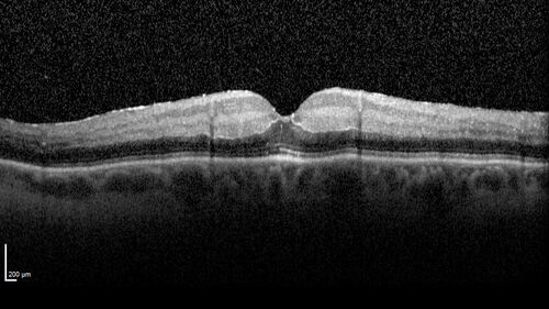 Central Retinal Artery Occlusion - Fluorescein Angiogram Video
63 year old man Sudden severe vision loss in the left eye for 3 days.  Six months following macula off retinal detachment repair, Pneumatic then PPV, then PPV buckle.  VA was 20/63 on 4/2021 (3 months post RD repair).
PMHx â€“ HTN.  Meds: HCT, Meloxicam
VA OD 20/25, OS HM
