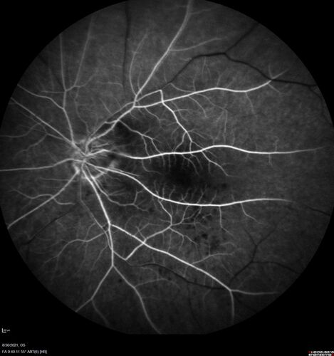 Central Retinal Artery Occlusion - Fluorescein Angiogram Video
63 year old man Sudden severe vision loss in the left eye for 3 days.  Six months following macula off retinal detachment repair, Pneumatic then PPV, then PPV buckle.  VA was 20/63 on 4/2021 (3 months post RD repair).
PMHx â€“ HTN.  Meds: HCT, Meloxicam
VA OD 20/25, OS HM
