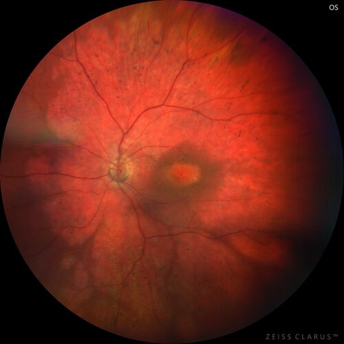 CRB1 Dystrophy - Inherited Retinal Disease - 14 year old male
Vision loss for 4 years OD 20/63, OS 20/160
