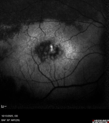 CRB1 Dystrophy - Inherited Retinal Disease - 14 year old male
Vision loss for 4 years OD 20/63, OS 20/160
