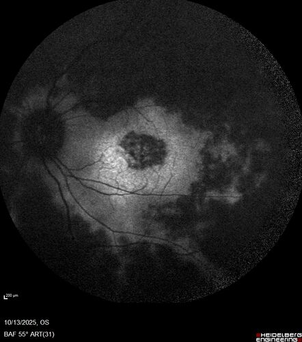 CRB1 Dystrophy - Inherited Retinal Disease - 14 year old male
Vision loss for 4 years OD 20/63, OS 20/160
