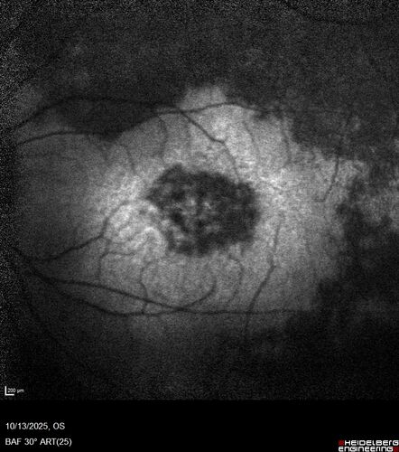 CRB1 Dystrophy - Inherited Retinal Disease - 14 year old male
Vision loss for 4 years OD 20/63, OS 20/160
