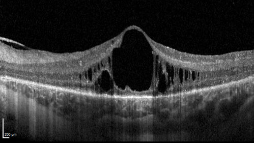 CRB1 Dystrophy - Inherited Retinal Disease - 14 year old male
Vision loss for 4 years OD 20/63, OS 20/160
