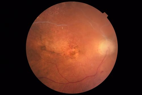 Ischemic CRVO OD and Arterial Macroaneurysm OS
83 year old female post PPV, Laser, Ahmed valve for CRVO with vitreous heme and NVG in the right eye.  VA was 20/160 3 months following vitrectomy.  Left eye has MA which was not treated and involuted post-heme

