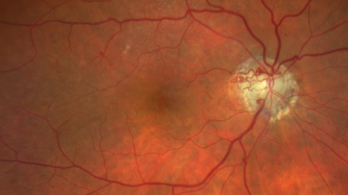 Sclerosed vein left eye

