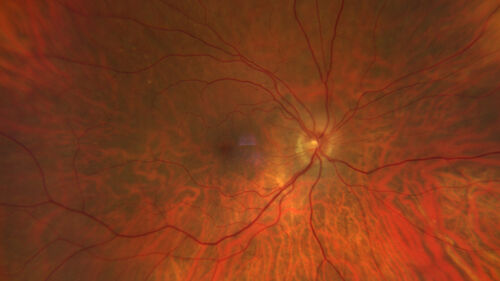 Central Retinal Vein Occlusion with cilioretinal artery occlusion
63 year old female who lost vision in the left eye 2 days ago. She was in the emergency room and had a lot of tests done which were all reportedly normal. The right eye is OK.
VA OD: Dcc20/25 NccJ2
VA OS: Dcc20/200-1 PHNI Ncc20/400-1
IOP: TP: OD:11 OS:12
