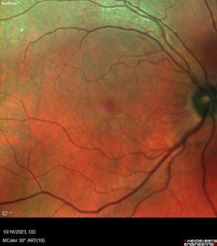 Central Retinal Vein Occlusion with cilioretinal artery occlusion
63 year old female who lost vision in the left eye 2 days ago. She was in the emergency room and had a lot of tests done which were all reportedly normal. The right eye is OK.
VA OD: Dcc20/25 NccJ2
VA OS: Dcc20/200-1 PHNI Ncc20/400-1
IOP: TP: OD:11 OS:12
