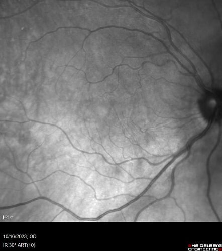 Central Retinal Vein Occlusion with cilioretinal artery occlusion
63 year old female who lost vision in the left eye 2 days ago. She was in the emergency room and had a lot of tests done which were all reportedly normal. The right eye is OK.
VA OD: Dcc20/25 NccJ2
VA OS: Dcc20/200-1 PHNI Ncc20/400-1
IOP: TP: OD:11 OS:12
