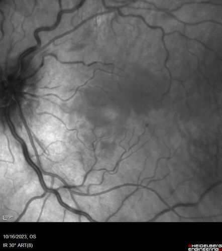 Central Retinal Vein Occlusion with cilioretinal artery occlusion
63 year old female who lost vision in the left eye 2 days ago. She was in the emergency room and had a lot of tests done which were all reportedly normal. The right eye is OK.
VA OD: Dcc20/25 NccJ2
VA OS: Dcc20/200-1 PHNI Ncc20/400-1
IOP: TP: OD:11 OS:12
