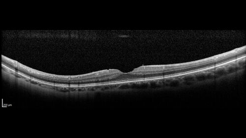 Central Retinal Vein Occlusion with cilioretinal artery occlusion
63 year old female who lost vision in the left eye 2 days ago. She was in the emergency room and had a lot of tests done which were all reportedly normal. The right eye is OK.
VA OD: Dcc20/25 NccJ2
VA OS: Dcc20/200-1 PHNI Ncc20/400-1
IOP: TP: OD:11 OS:12
