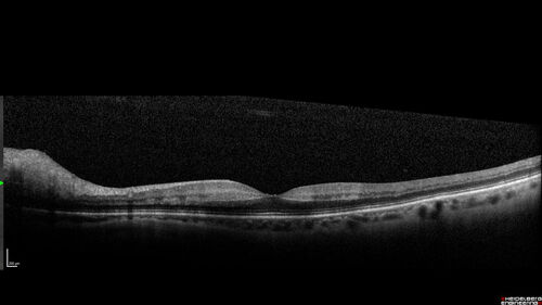 Central Retinal Vein Occlusion with cilioretinal artery occlusion
63 year old female who lost vision in the left eye 2 days ago. She was in the emergency room and had a lot of tests done which were all reportedly normal. The right eye is OK.
VA OD: Dcc20/25 NccJ2
VA OS: Dcc20/200-1 PHNI Ncc20/400-1
IOP: TP: OD:11 OS:12
