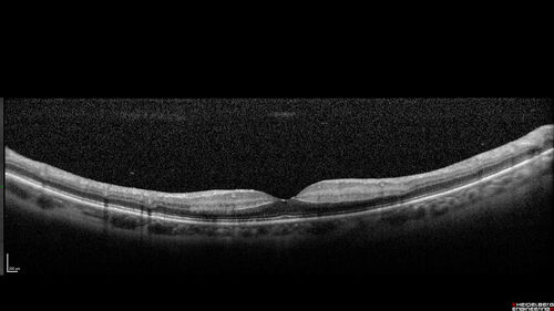 Central Retinal Vein Occlusion with cilioretinal artery occlusion
63 year old female who lost vision in the left eye 2 days ago. She was in the emergency room and had a lot of tests done which were all reportedly normal. The right eye is OK.
VA OD: Dcc20/25 NccJ2
VA OS: Dcc20/200-1 PHNI Ncc20/400-1
IOP: TP: OD:11 OS:12
