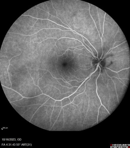 Central Retinal Vein Occlusion with cilioretinal artery occlusion
63 year old female who lost vision in the left eye 2 days ago. She was in the emergency room and had a lot of tests done which were all reportedly normal. The right eye is OK.
VA OD: Dcc20/25 NccJ2
VA OS: Dcc20/200-1 PHNI Ncc20/400-1
IOP: TP: OD:11 OS:12

