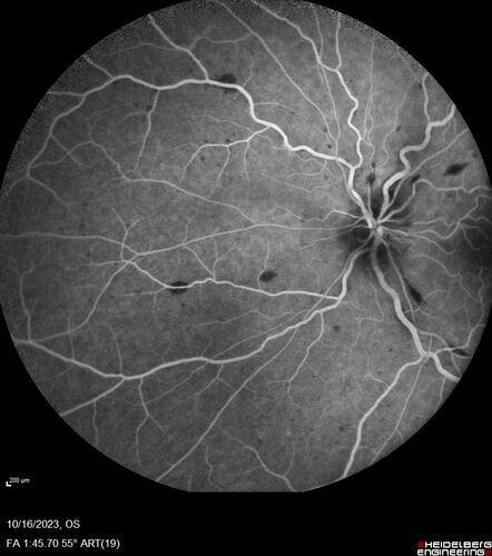 Central Retinal Vein Occlusion with cilioretinal artery occlusion
63 year old female who lost vision in the left eye 2 days ago. She was in the emergency room and had a lot of tests done which were all reportedly normal. The right eye is OK.
VA OD: Dcc20/25 NccJ2
VA OS: Dcc20/200-1 PHNI Ncc20/400-1
IOP: TP: OD:11 OS:12
