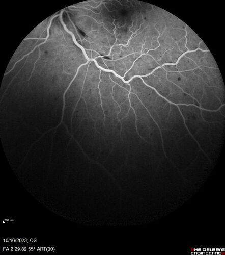 Central Retinal Vein Occlusion with cilioretinal artery occlusion
63 year old female who lost vision in the left eye 2 days ago. She was in the emergency room and had a lot of tests done which were all reportedly normal. The right eye is OK.
VA OD: Dcc20/25 NccJ2
VA OS: Dcc20/200-1 PHNI Ncc20/400-1
IOP: TP: OD:11 OS:12
