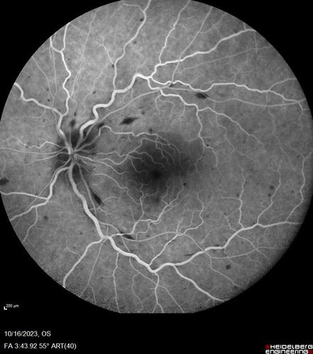 Central Retinal Vein Occlusion with cilioretinal artery occlusion
63 year old female who lost vision in the left eye 2 days ago. She was in the emergency room and had a lot of tests done which were all reportedly normal. The right eye is OK.
VA OD: Dcc20/25 NccJ2
VA OS: Dcc20/200-1 PHNI Ncc20/400-1
IOP: TP: OD:11 OS:12
