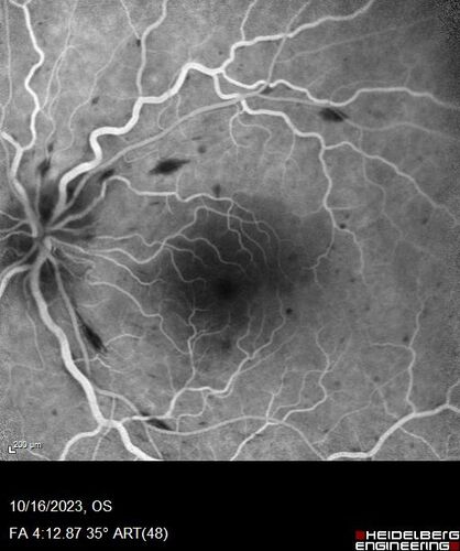 Central Retinal Vein Occlusion with cilioretinal artery occlusion
63 year old female who lost vision in the left eye 2 days ago. She was in the emergency room and had a lot of tests done which were all reportedly normal. The right eye is OK.
VA OD: Dcc20/25 NccJ2
VA OS: Dcc20/200-1 PHNI Ncc20/400-1
IOP: TP: OD:11 OS:12
