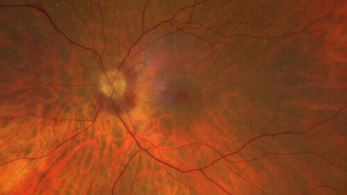 Central Retinal Vein Occlusion with cilioretinal artery occlusion
63 year old female who lost vision in the left eye 2 days ago. She was in the emergency room and had a lot of tests done which were all reportedly normal. The right eye is OK.
VA OD: Dcc20/25 NccJ2
VA OS: Dcc20/200-1 PHNI Ncc20/400-1
IOP: TP: OD:11 OS:12
