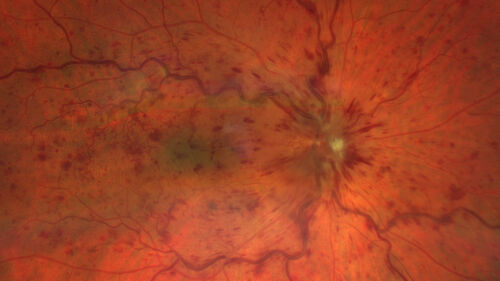 Central Retinal Vein Occlusion - Non-Ischemic - Excellent Outcome
57 year old man The right eye has had vision loss for about 3 weeks.  He woke up with vision loss. 
Medical Hx: HIV . Diabetes Mellitus (since 2014). Thyroid Disease. 
Systemic Meds: gemboya. Metformin Hydrochloride. trulicity. losartan. vesepa. Synthroid .
VA OD: sc20/160 OS: sc20/20 
TP: OD:14 OS:14
Treated with Avastin
VA 6 weeks later 20/32 – dry one shot.
Missed follow-up after second treatment and came  5 months later with good vision and no macular edema
