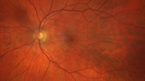 Central Retinal Vein Occlusion - Non-Ischemic - Excellent Outcome
57 year old man The right eye has had vision loss for about 3 weeks.  He woke up with vision loss. 
Medical Hx: HIV . Diabetes Mellitus (since 2014). Thyroid Disease. 
Systemic Meds: gemboya. Metformin Hydrochloride. trulicity. losartan. vesepa. Synthroid .
VA OD: sc20/160 OS: sc20/20 
TP: OD:14 OS:14
Treated with Avastin
VA 6 weeks later 20/32 – dry one shot.
Missed follow-up after second treatment and came  5 months later with good vision and no macular edema
