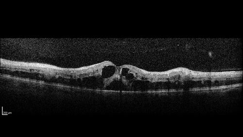 Central Retinal Vein Occlusion - Non-Ischemic - Excellent Outcome
57 year old man The right eye has had vision loss for about 3 weeks.  He woke up with vision loss. 
Medical Hx: HIV . Diabetes Mellitus (since 2014). Thyroid Disease. 
Systemic Meds: gemboya. Metformin Hydrochloride. trulicity. losartan. vesepa. Synthroid .
VA OD: sc20/160 OS: sc20/20 
TP: OD:14 OS:14
Treated with Avastin
VA 6 weeks later 20/32 – dry one shot.
Missed follow-up after second treatment and came  5 months later with good vision and no macular edema
