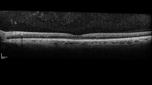 Central Retinal Vein Occlusion - Non-Ischemic - Excellent Outcome
57 year old man The right eye has had vision loss for about 3 weeks.  He woke up with vision loss. 
Medical Hx: HIV . Diabetes Mellitus (since 2014). Thyroid Disease. 
Systemic Meds: gemboya. Metformin Hydrochloride. trulicity. losartan. vesepa. Synthroid .
VA OD: sc20/160 OS: sc20/20 
TP: OD:14 OS:14
Treated with Avastin
VA 6 weeks later 20/32 – dry one shot.
Missed follow-up after second treatment and came  5 months later with good vision and no macular edema
