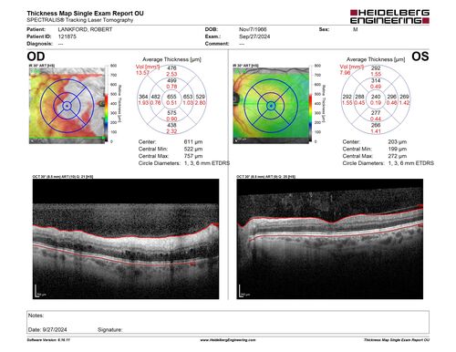 Central Retinal Vein Occlusion - Non-Ischemic - Excellent Outcome
57 year old man The right eye has had vision loss for about 3 weeks.  He woke up with vision loss. 
Medical Hx: HIV . Diabetes Mellitus (since 2014). Thyroid Disease. 
Systemic Meds: gemboya. Metformin Hydrochloride. trulicity. losartan. vesepa. Synthroid .
VA OD: sc20/160 OS: sc20/20 
TP: OD:14 OS:14
Treated with Avastin
VA 6 weeks later 20/32 – dry one shot.
Missed follow-up after second treatment and came  5 months later with good vision and no macular edema
