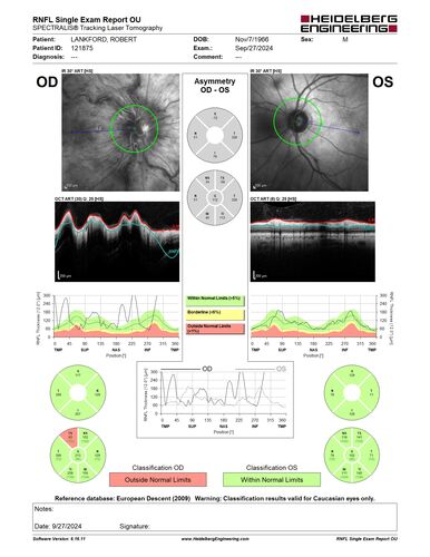 Central Retinal Vein Occlusion - Non-Ischemic - Excellent Outcome
57 year old man The right eye has had vision loss for about 3 weeks.  He woke up with vision loss. 
Medical Hx: HIV . Diabetes Mellitus (since 2014). Thyroid Disease. 
Systemic Meds: gemboya. Metformin Hydrochloride. trulicity. losartan. vesepa. Synthroid .
VA OD: sc20/160 OS: sc20/20 
TP: OD:14 OS:14
Treated with Avastin
VA 6 weeks later 20/32 – dry one shot.
Missed follow-up after second treatment and came  5 months later with good vision and no macular edema

