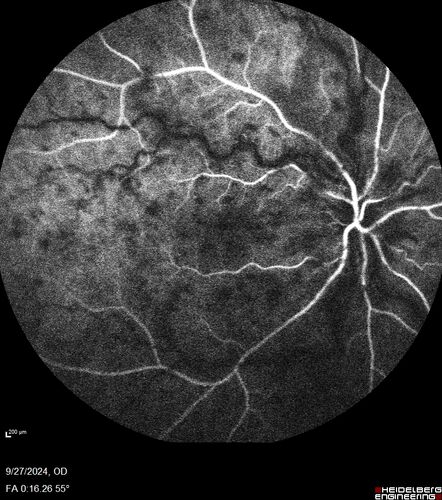 Central Retinal Vein Occlusion - Non-Ischemic - Excellent Outcome
57 year old man The right eye has had vision loss for about 3 weeks.  He woke up with vision loss. 
Medical Hx: HIV . Diabetes Mellitus (since 2014). Thyroid Disease. 
Systemic Meds: gemboya. Metformin Hydrochloride. trulicity. losartan. vesepa. Synthroid .
VA OD: sc20/160 OS: sc20/20 
TP: OD:14 OS:14
Treated with Avastin
VA 6 weeks later 20/32 – dry one shot.
Missed follow-up after second treatment and came  5 months later with good vision and no macular edema

