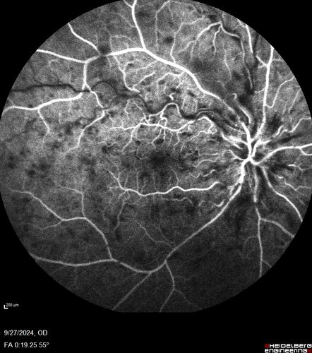 Central Retinal Vein Occlusion - Non-Ischemic - Excellent Outcome
57 year old man The right eye has had vision loss for about 3 weeks.  He woke up with vision loss. 
Medical Hx: HIV . Diabetes Mellitus (since 2014). Thyroid Disease. 
Systemic Meds: gemboya. Metformin Hydrochloride. trulicity. losartan. vesepa. Synthroid .
VA OD: sc20/160 OS: sc20/20 
TP: OD:14 OS:14
Treated with Avastin
VA 6 weeks later 20/32 – dry one shot.
Missed follow-up after second treatment and came  5 months later with good vision and no macular edema
