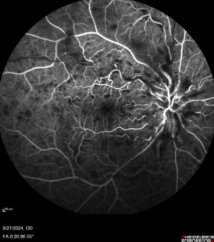 Central Retinal Vein Occlusion - Non-Ischemic - Excellent Outcome
57 year old man The right eye has had vision loss for about 3 weeks.  He woke up with vision loss. 
Medical Hx: HIV . Diabetes Mellitus (since 2014). Thyroid Disease. 
Systemic Meds: gemboya. Metformin Hydrochloride. trulicity. losartan. vesepa. Synthroid .
VA OD: sc20/160 OS: sc20/20 
TP: OD:14 OS:14
Treated with Avastin
VA 6 weeks later 20/32 – dry one shot.
Missed follow-up after second treatment and came  5 months later with good vision and no macular edema
