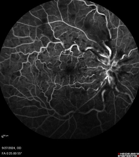 Central Retinal Vein Occlusion - Non-Ischemic - Excellent Outcome
57 year old man The right eye has had vision loss for about 3 weeks.  He woke up with vision loss. 
Medical Hx: HIV . Diabetes Mellitus (since 2014). Thyroid Disease. 
Systemic Meds: gemboya. Metformin Hydrochloride. trulicity. losartan. vesepa. Synthroid .
VA OD: sc20/160 OS: sc20/20 
TP: OD:14 OS:14
Treated with Avastin
VA 6 weeks later 20/32 – dry one shot.
Missed follow-up after second treatment and came  5 months later with good vision and no macular edema
