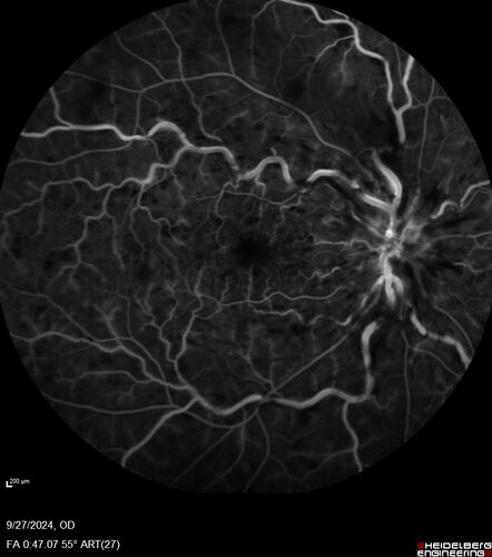Central Retinal Vein Occlusion - Non-Ischemic - Excellent Outcome
57 year old man The right eye has had vision loss for about 3 weeks.  He woke up with vision loss. 
Medical Hx: HIV . Diabetes Mellitus (since 2014). Thyroid Disease. 
Systemic Meds: gemboya. Metformin Hydrochloride. trulicity. losartan. vesepa. Synthroid .
VA OD: sc20/160 OS: sc20/20 
TP: OD:14 OS:14
Treated with Avastin
VA 6 weeks later 20/32 – dry one shot.
Missed follow-up after second treatment and came  5 months later with good vision and no macular edema
