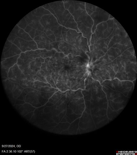 Central Retinal Vein Occlusion - Non-Ischemic - Excellent Outcome
57 year old man The right eye has had vision loss for about 3 weeks.  He woke up with vision loss. 
Medical Hx: HIV . Diabetes Mellitus (since 2014). Thyroid Disease. 
Systemic Meds: gemboya. Metformin Hydrochloride. trulicity. losartan. vesepa. Synthroid .
VA OD: sc20/160 OS: sc20/20 
TP: OD:14 OS:14
Treated with Avastin
VA 6 weeks later 20/32 – dry one shot.
Missed follow-up after second treatment and came  5 months later with good vision and no macular edema
