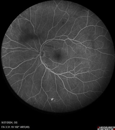 Central Retinal Vein Occlusion - Non-Ischemic - Excellent Outcome
57 year old man The right eye has had vision loss for about 3 weeks.  He woke up with vision loss. 
Medical Hx: HIV . Diabetes Mellitus (since 2014). Thyroid Disease. 
Systemic Meds: gemboya. Metformin Hydrochloride. trulicity. losartan. vesepa. Synthroid .
VA OD: sc20/160 OS: sc20/20 
TP: OD:14 OS:14
Treated with Avastin
VA 6 weeks later 20/32 – dry one shot.
Missed follow-up after second treatment and came  5 months later with good vision and no macular edema

