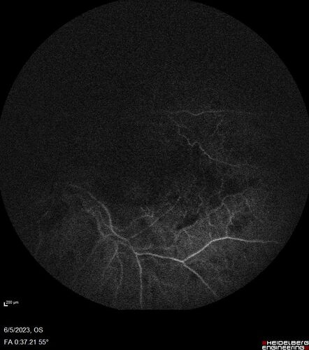 central retinal vein occlusion - a lot of hemorrhage - on coumadin
84 year old man with severe vision loss left eye for 2 weeks.  VA 5/200 OS - Patient on Warfarin for valve replacement.
