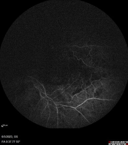 central retinal vein occlusion - a lot of hemorrhage - on coumadin
84 year old man with severe vision loss left eye for 2 weeks.  VA 5/200 OS - Patient on Warfarin for valve replacement.
