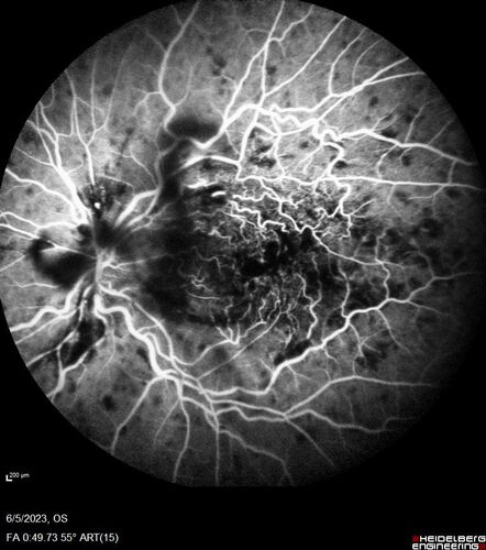 central retinal vein occlusion - a lot of hemorrhage - on coumadin
84 year old man with severe vision loss left eye for 2 weeks.  VA 5/200 OS - Patient on Warfarin for valve replacement.
