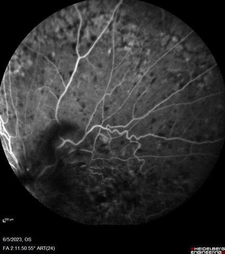 central retinal vein occlusion - a lot of hemorrhage - on coumadin
84 year old man with severe vision loss left eye for 2 weeks.  VA 5/200 OS - Patient on Warfarin for valve replacement.
