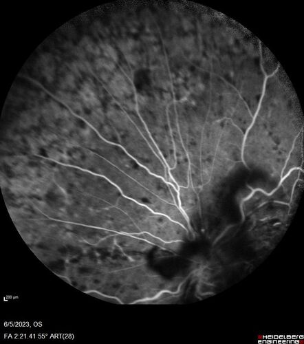 central retinal vein occlusion - a lot of hemorrhage - on coumadin
84 year old man with severe vision loss left eye for 2 weeks.  VA 5/200 OS - Patient on Warfarin for valve replacement.

