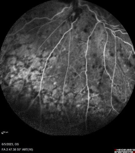 central retinal vein occlusion - a lot of hemorrhage - on coumadin
84 year old man with severe vision loss left eye for 2 weeks.  VA 5/200 OS - Patient on Warfarin for valve replacement.
