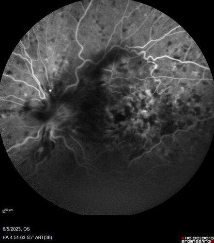 central retinal vein occlusion - a lot of hemorrhage - on coumadin
84 year old man with severe vision loss left eye for 2 weeks.  VA 5/200 OS - Patient on Warfarin for valve replacement.
